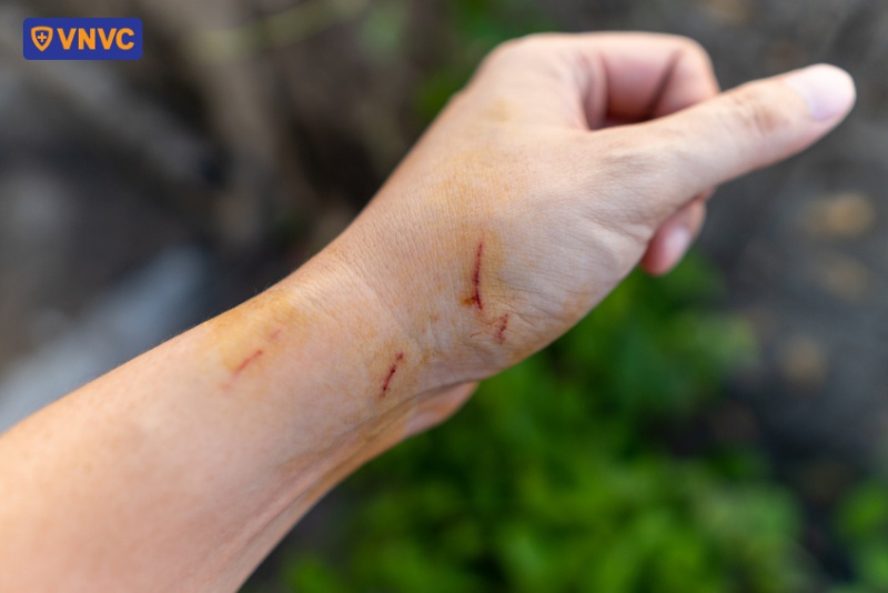 vết xước do động vật cào
