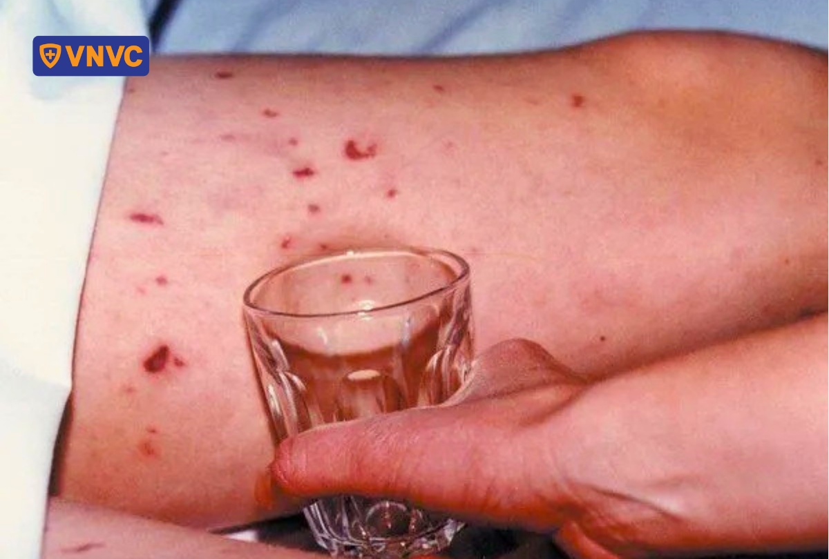 ban xuất huyết đỏ sẫm