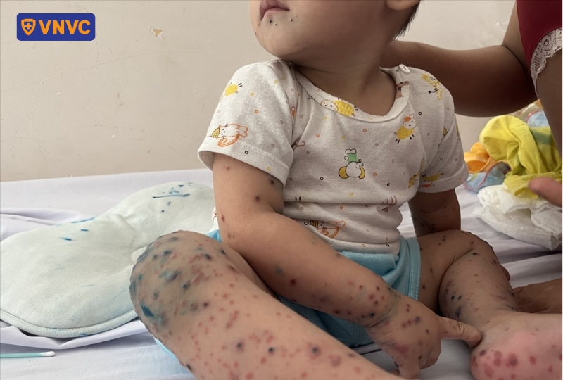 bé phát ban ngoài da