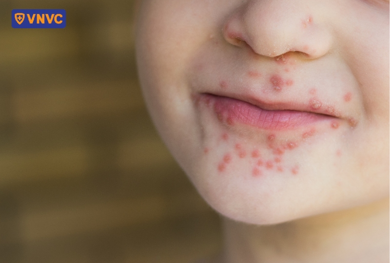 mẩn đỏ quanh miệng bé