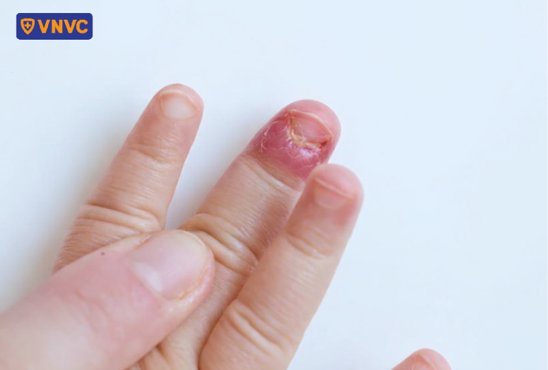 móng tay bé bị bong ra