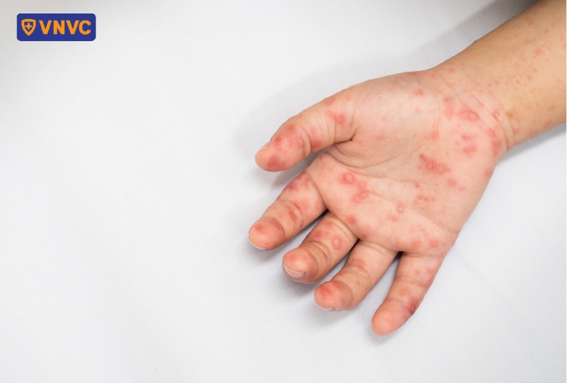 nốt tay chân miệng trên bàn tay