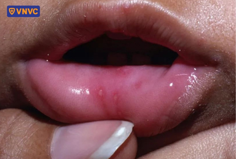 nốt tay chân miệng trên môi