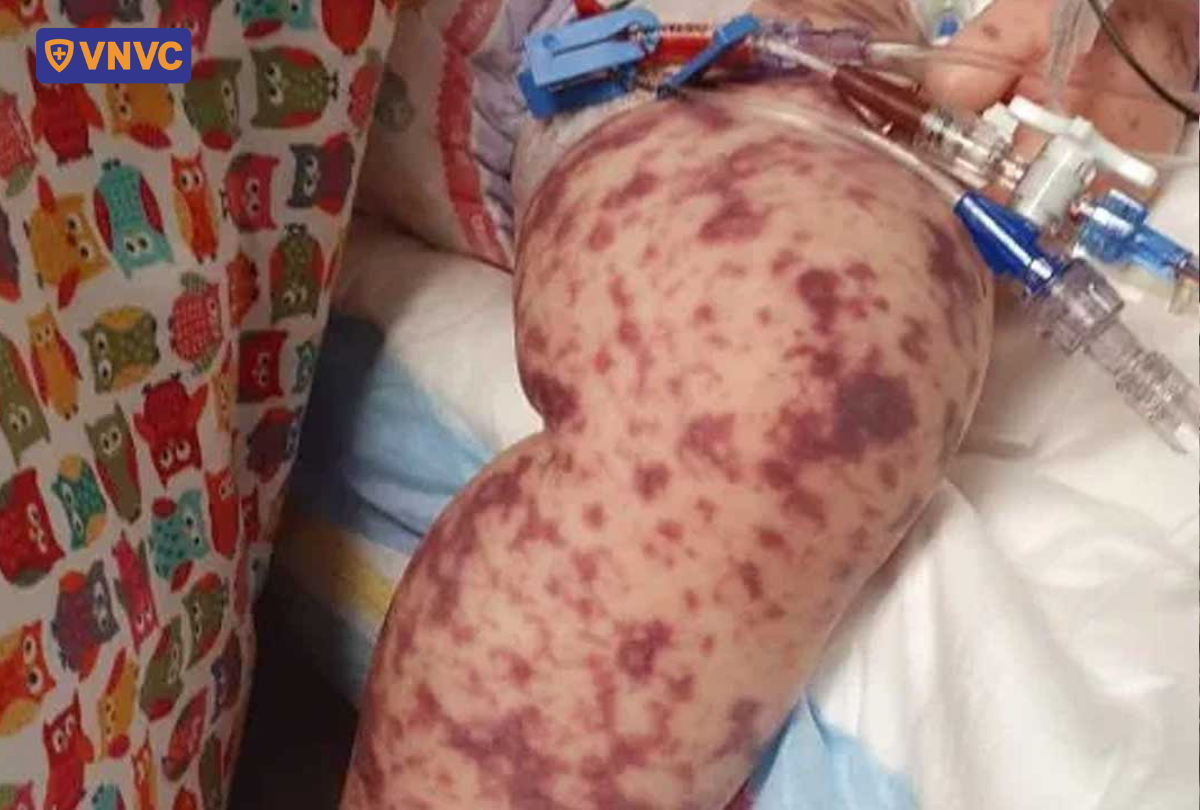 nót tử ban hình sao trên chân