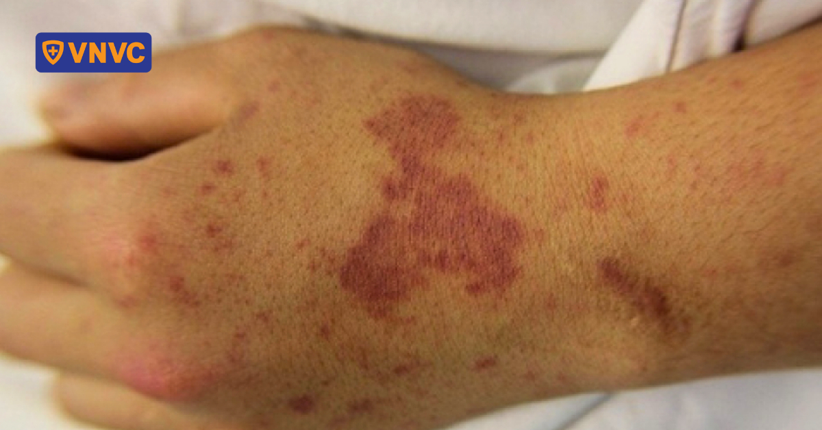 TP.HCM ghi nhận thêm ca não mô cầu khiến em bé tử vong