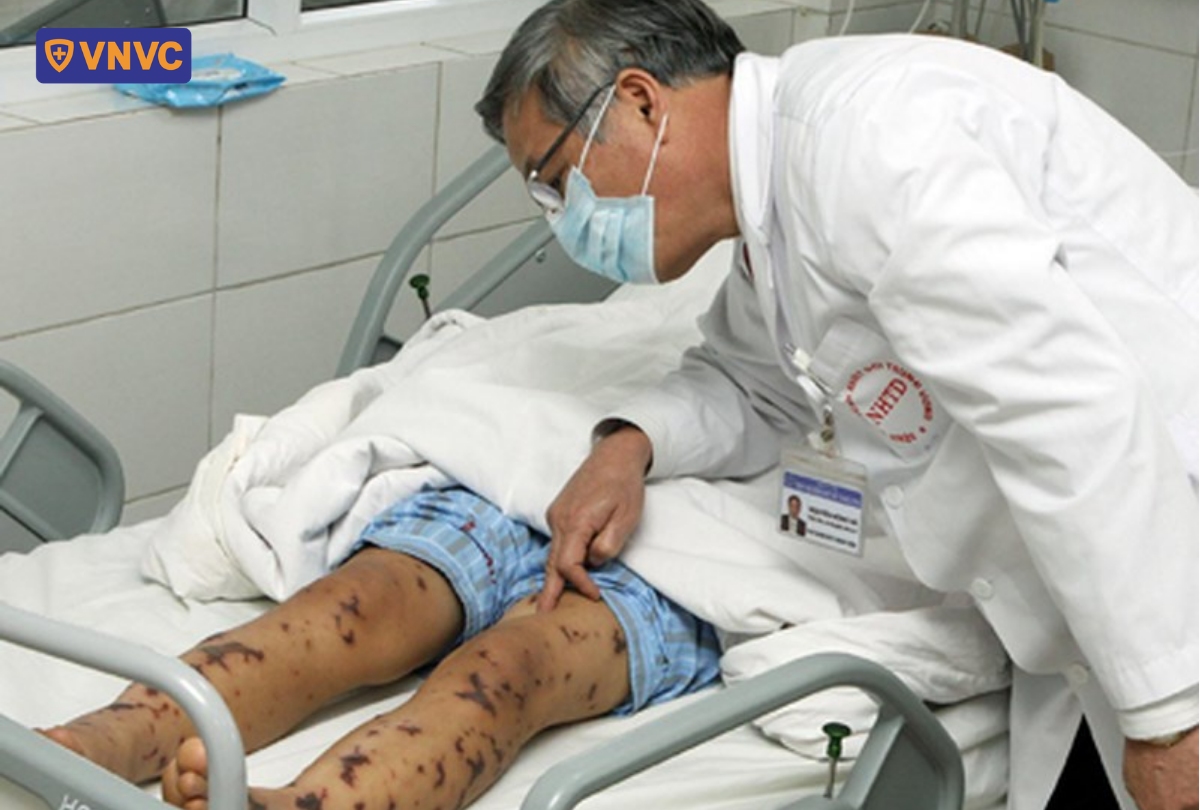 biểu hiện nhiễm bệnh não mô cầu nặng