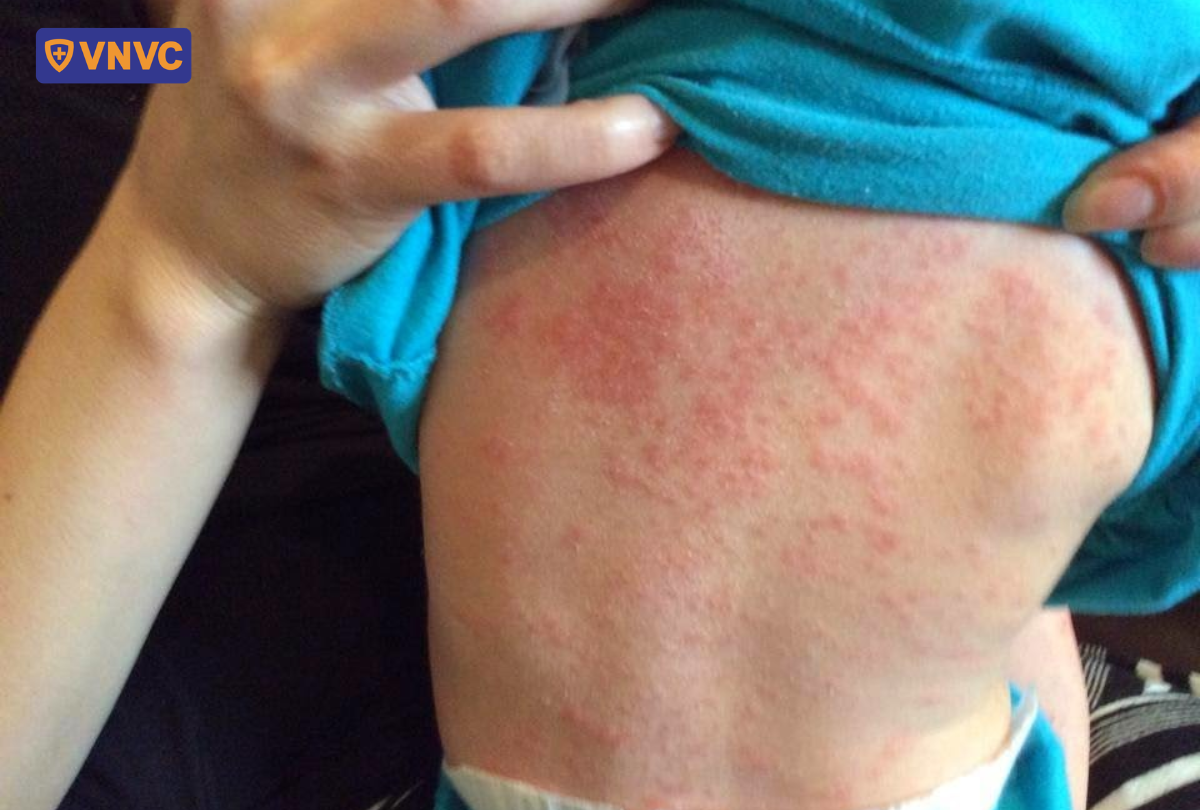 các nốt đỏ trên lưng trẻ