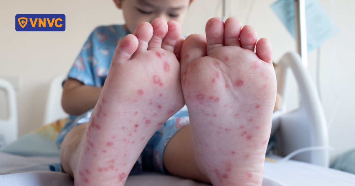 Sai lầm thường gặp khi chăm sóc trẻ mắc tay chân miệng tại nhà