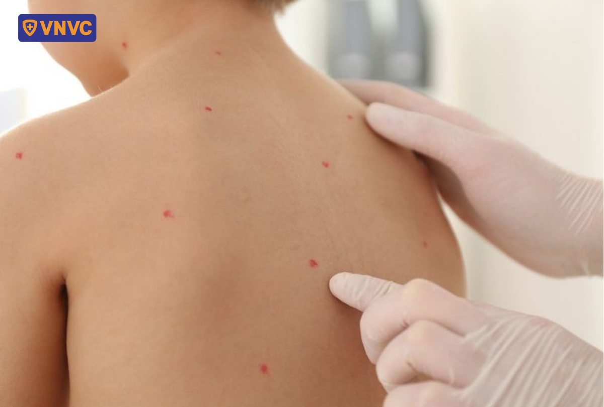 chỉ tay vào nốt thủy đậu