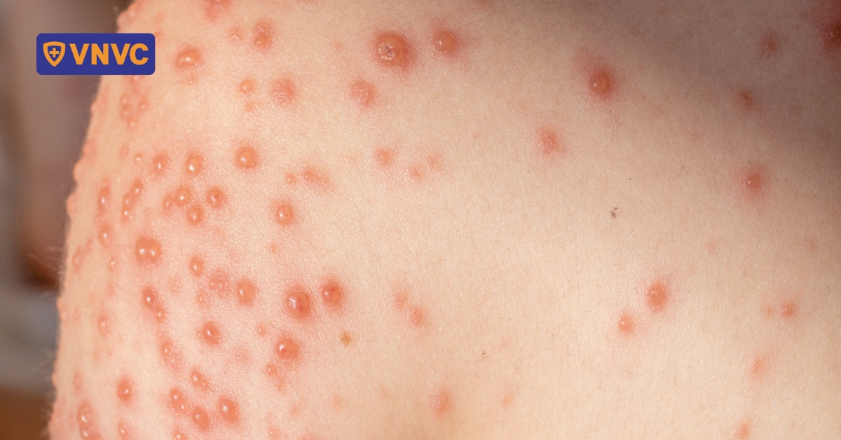 Chú ý phòng bệnh khi thủy đậu vào mùa!