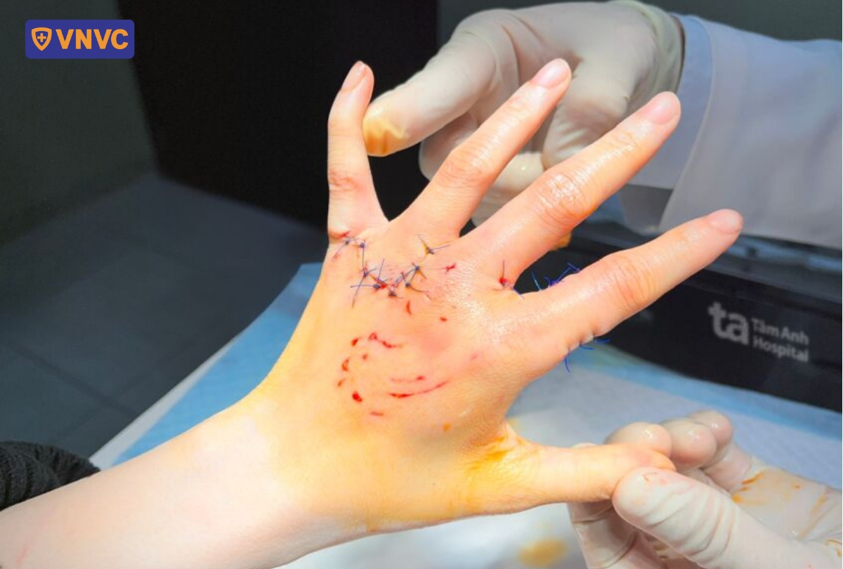 khâu vết thương do chó dại cắn