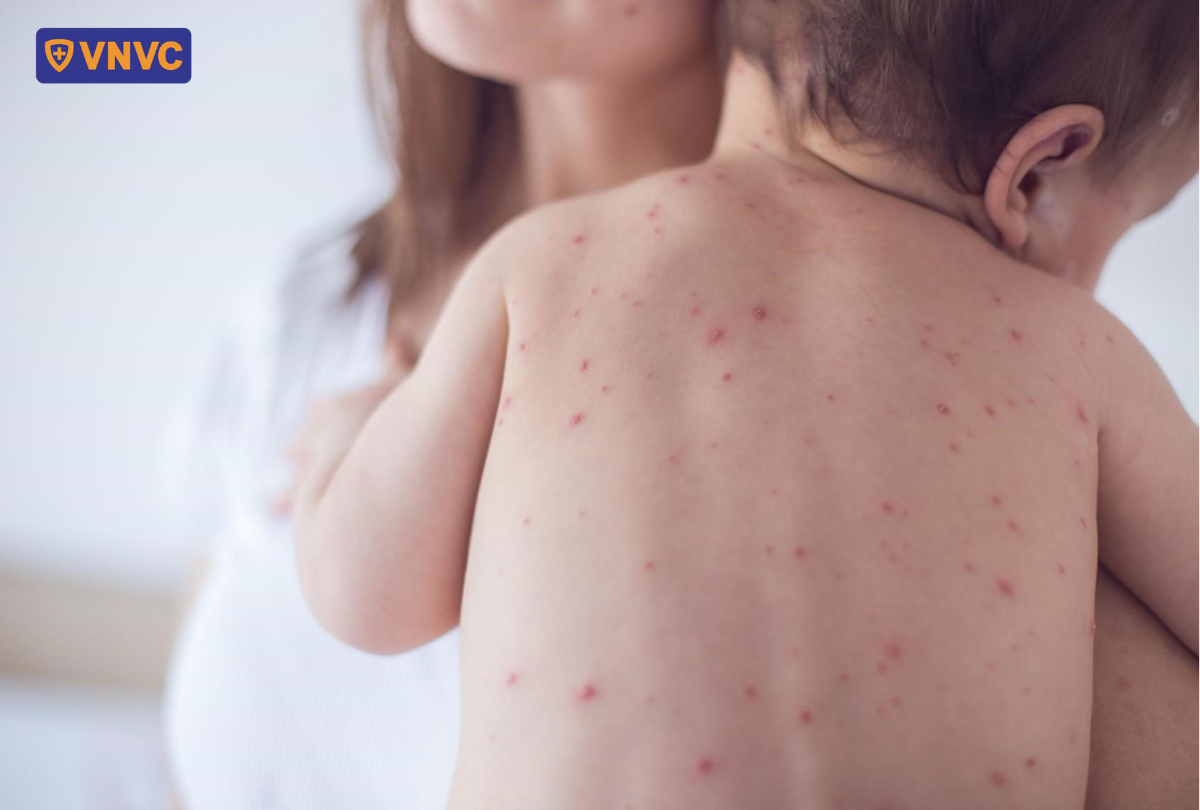 lưng trẻ nổi thủy đậu