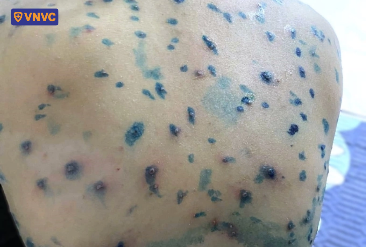 mụn nước thủy đậu có bôi thuốc