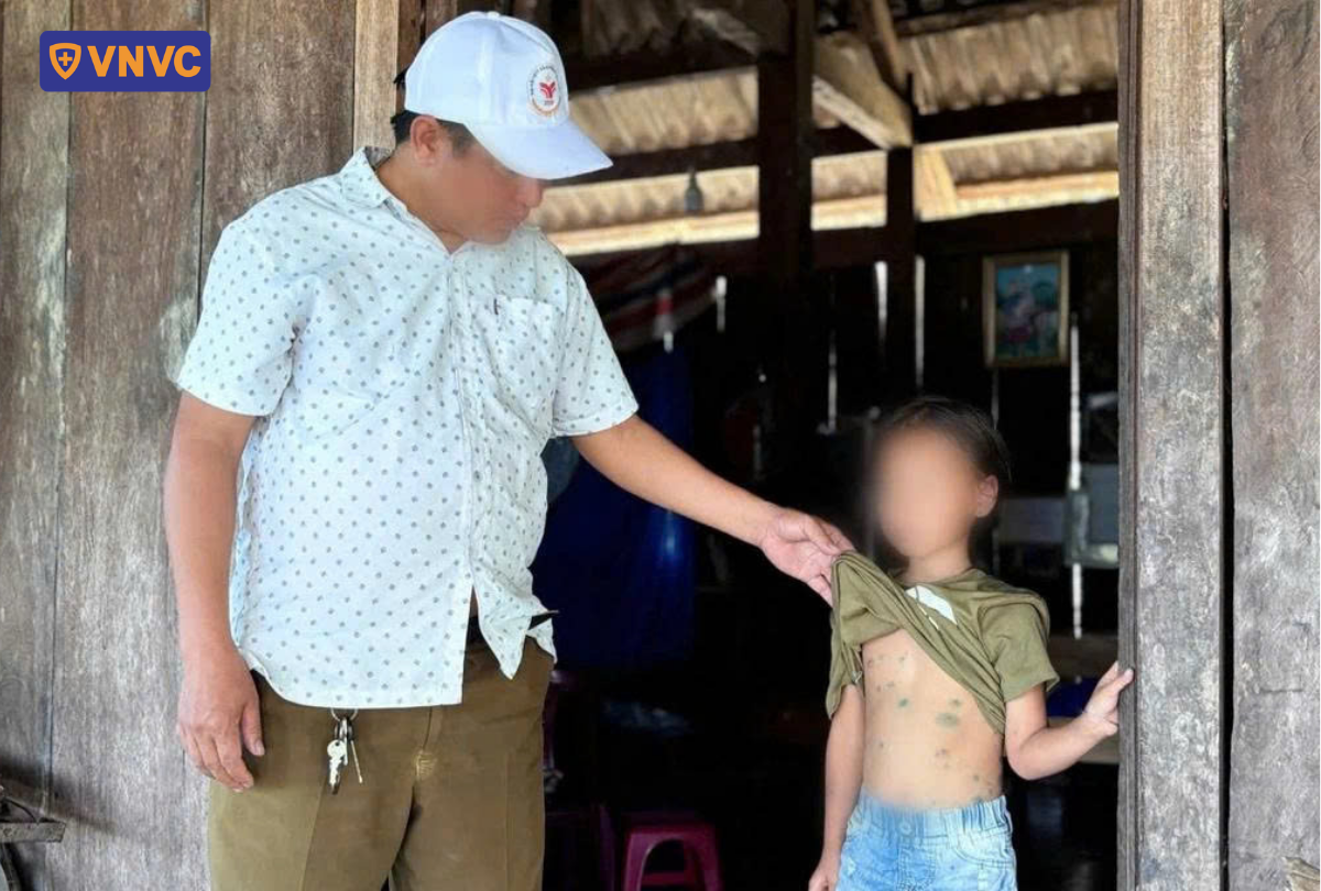 người lớn và em bé bị thủy đậu