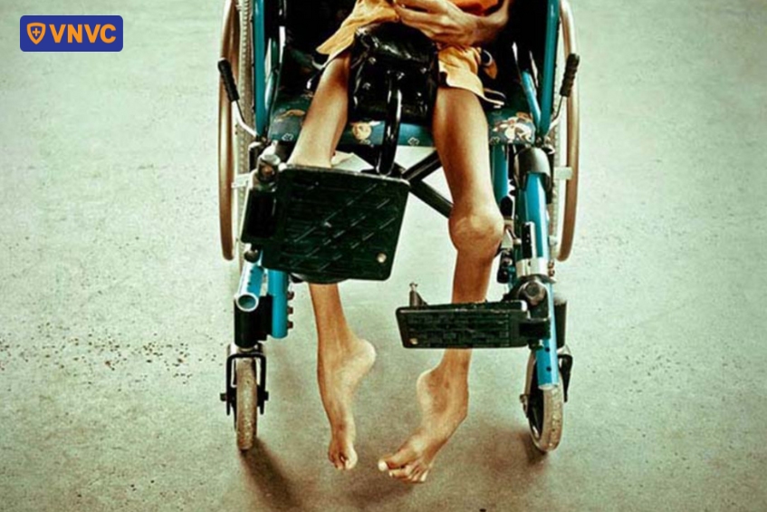 nguy cơ tàn tật từ bệnh bại liệt