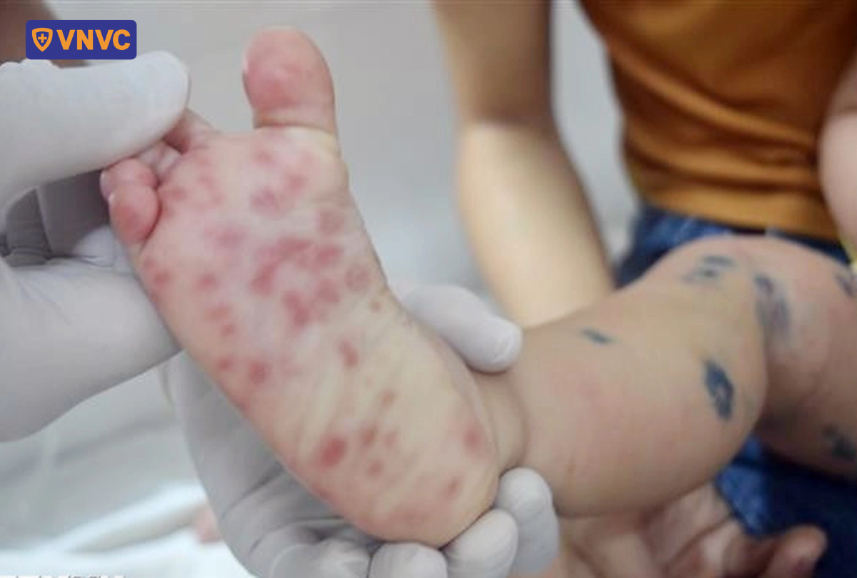 nốt đỏ ở lòng bàn chân