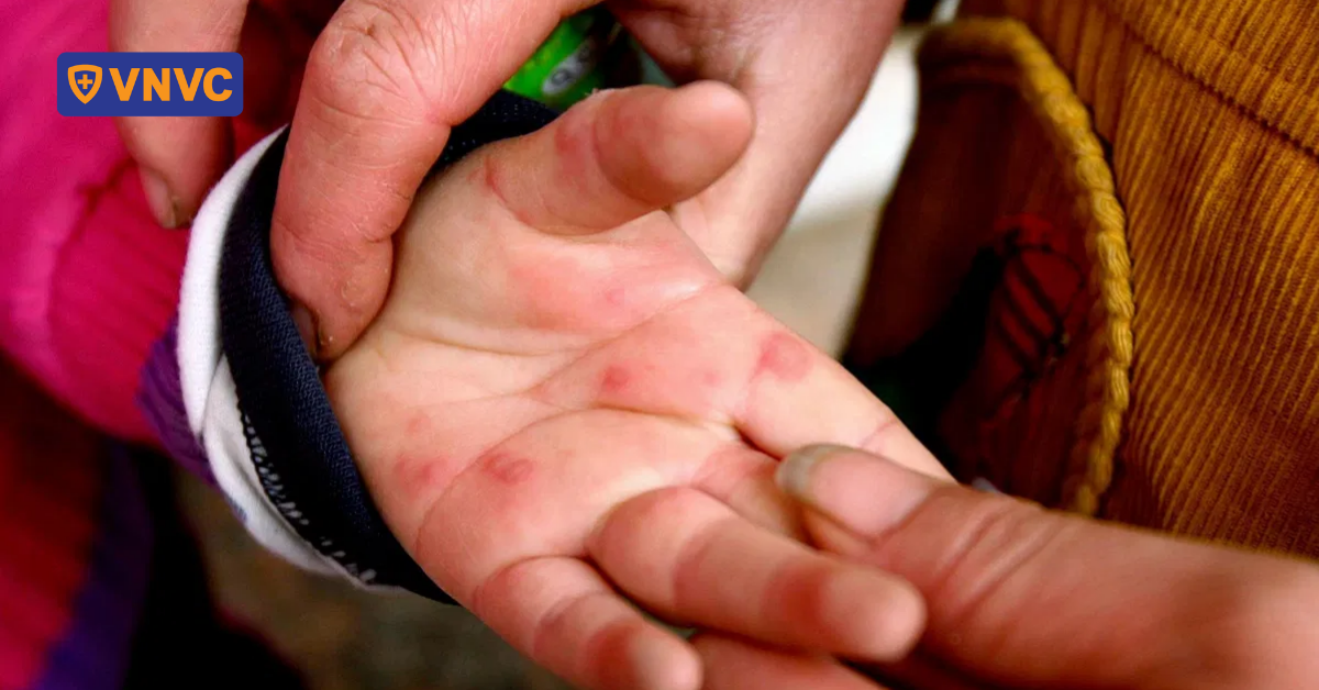 Vì sao tay chân miệng dễ bùng dịch tại các đô thị lớn?