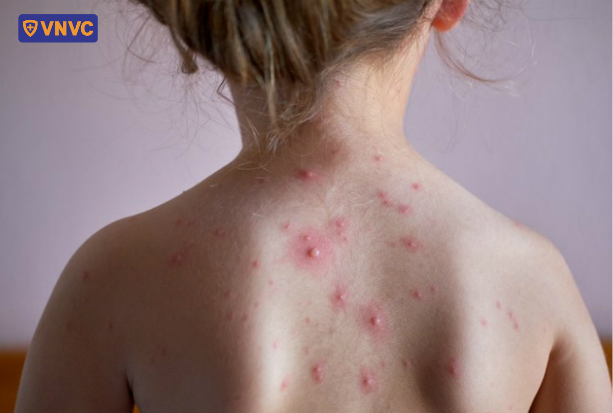 nốt thủy đậu nổi trên lưng