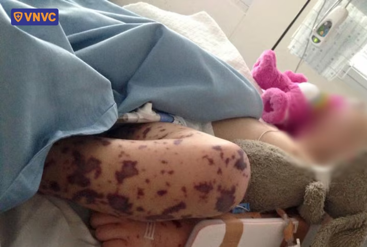 nốt tử ban ở bệnh nhi mắc viêm màng não mô cầu