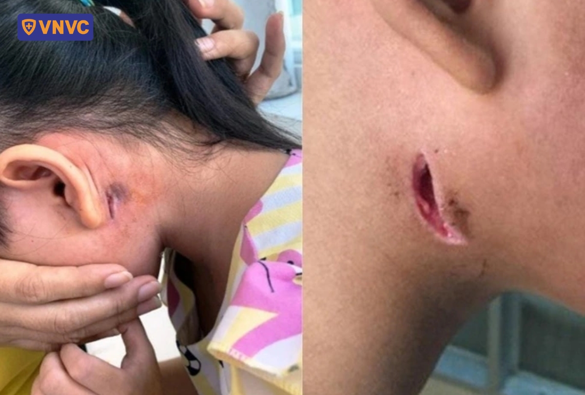 trẻ bị loét da nghiêm trọng