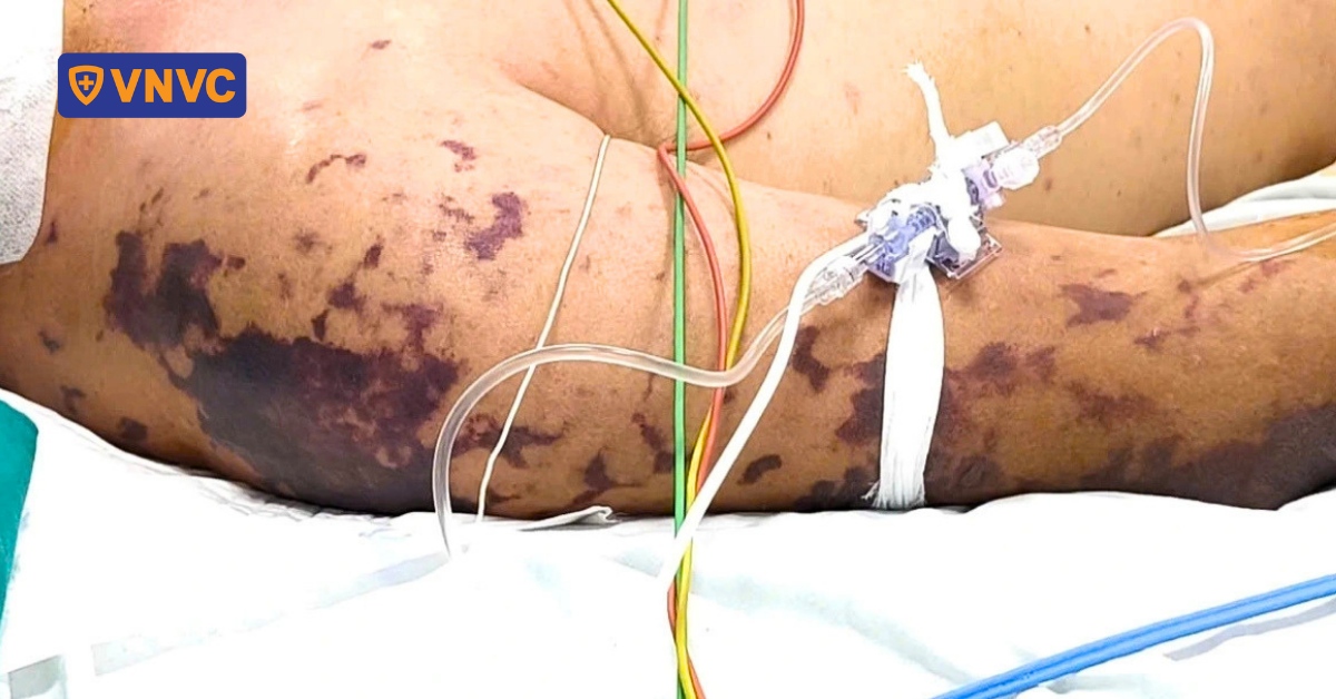 Cà Mau có 3 ca nghi não mô cầu, đã có tử vong: Lo lắng về nguy cơ lây lan