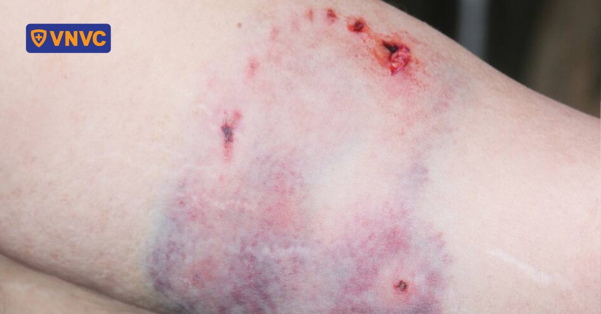 Đợi vết cắn chảy máu mới tiêm phòng dại?