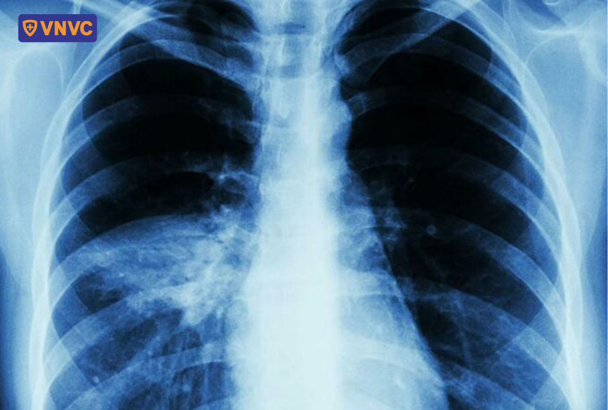 xquang lồng ngực