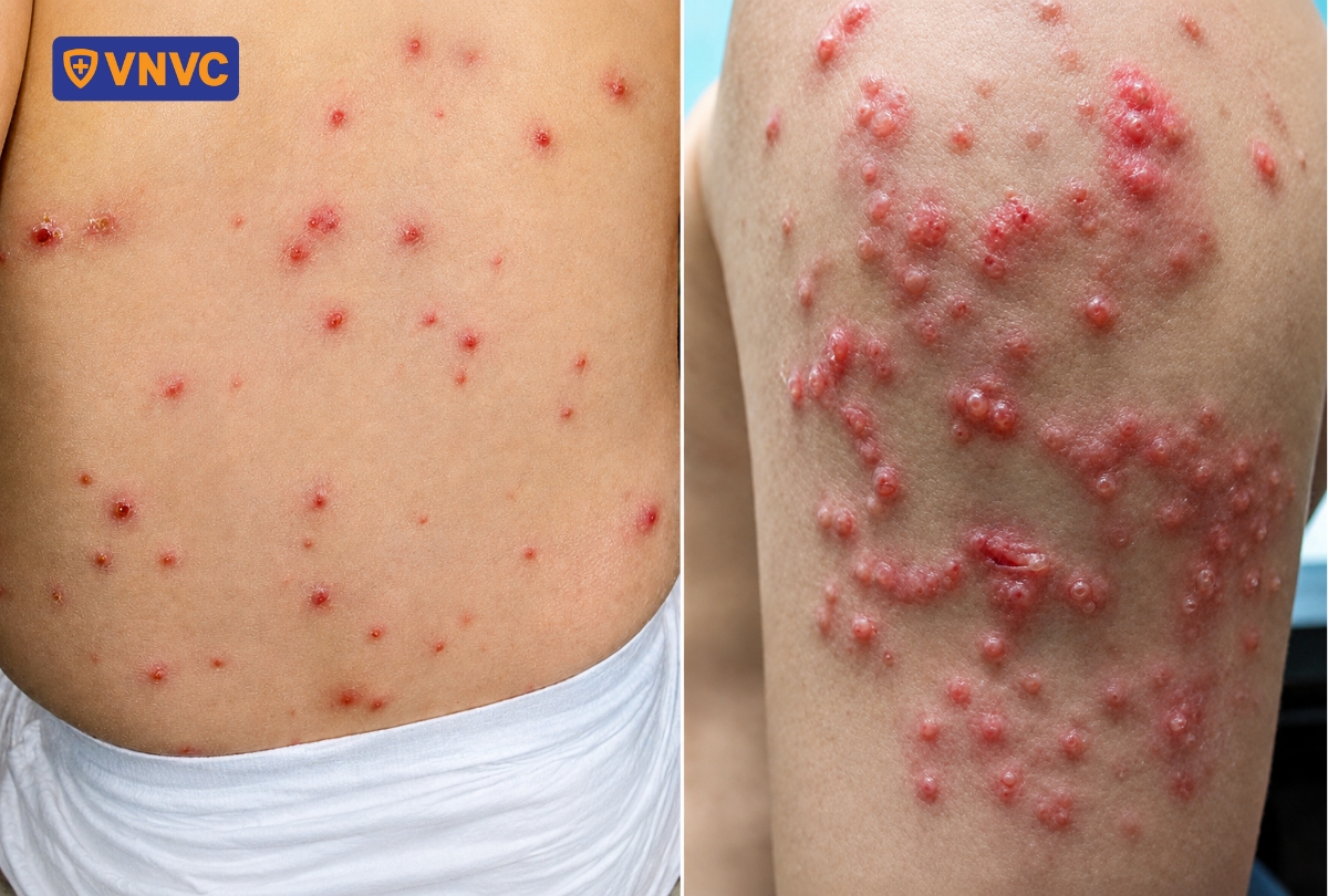 hình ảnh mắc zona thần kinh và thủy đậu cùng lúc