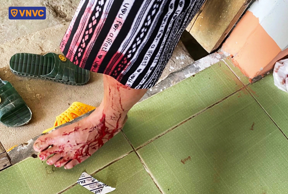 nạn nhân bị chó dại cắn