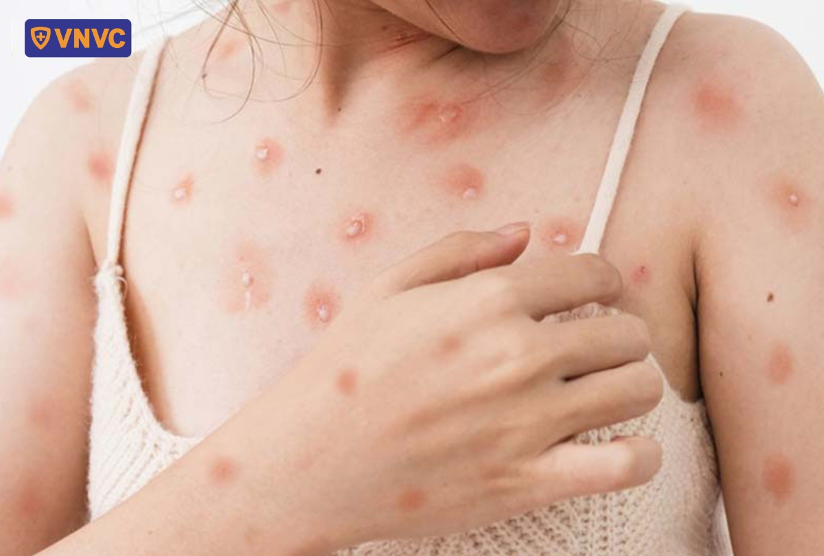 nốt thủy đậu nổi trên người