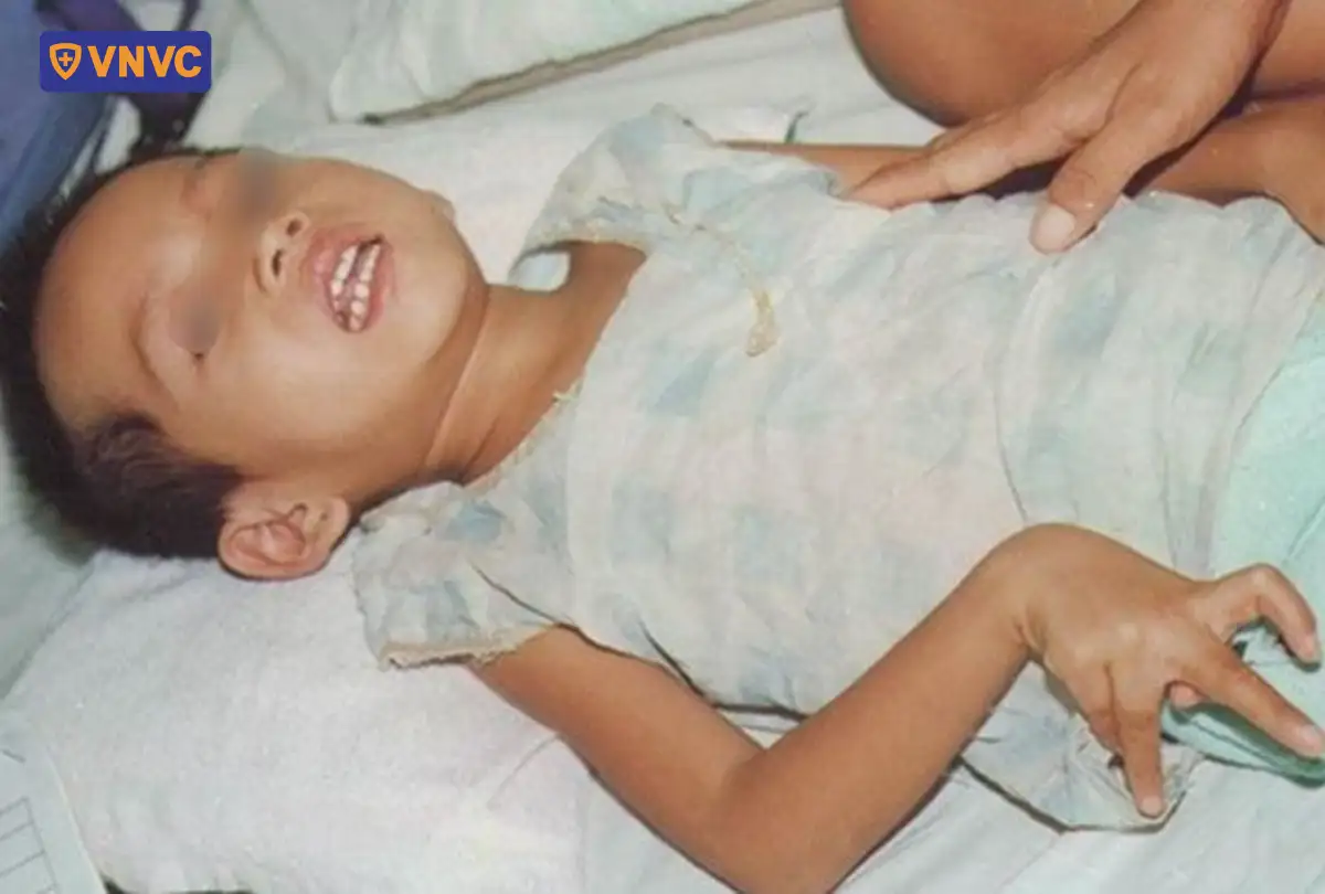 trẻ bị co cứng tay chân