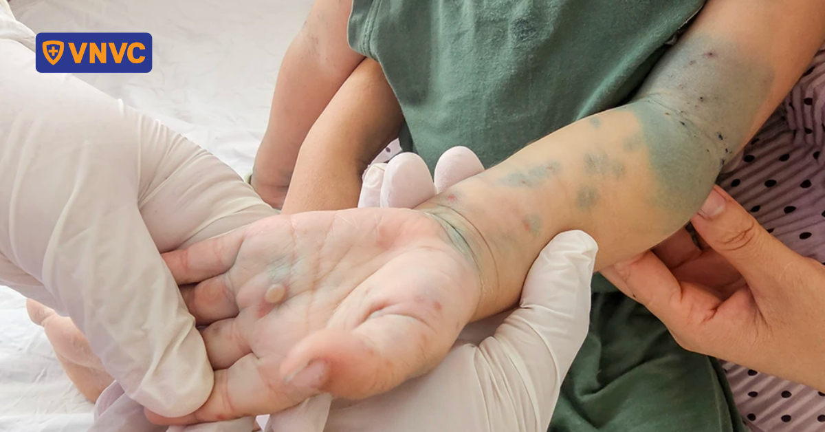 Nguy cơ tay chân miệng nặng gia tăng ở trẻ nhỏ do virus đang thay đổi