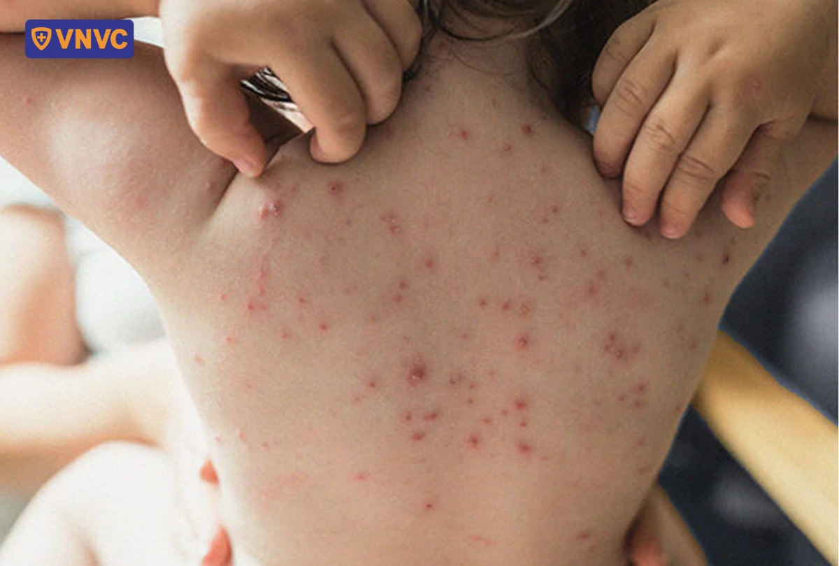 bệnh thủy đậu trên lưng bé