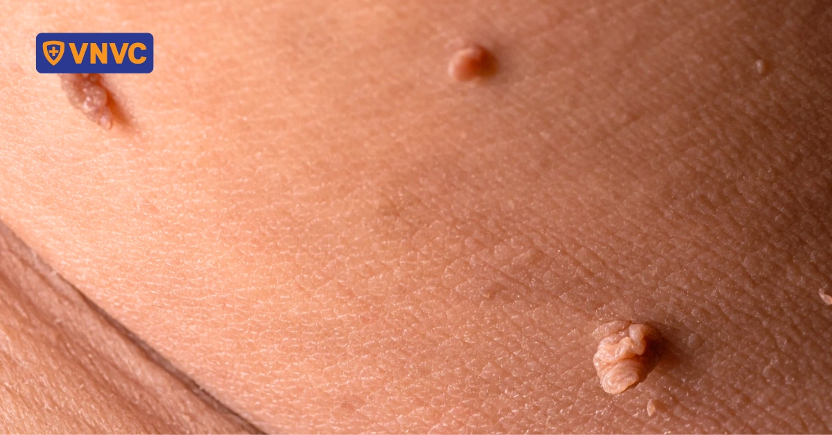 12% bé trai trong độ tuổi tiền dậy thì nhiễm virus HPV gây ung thư