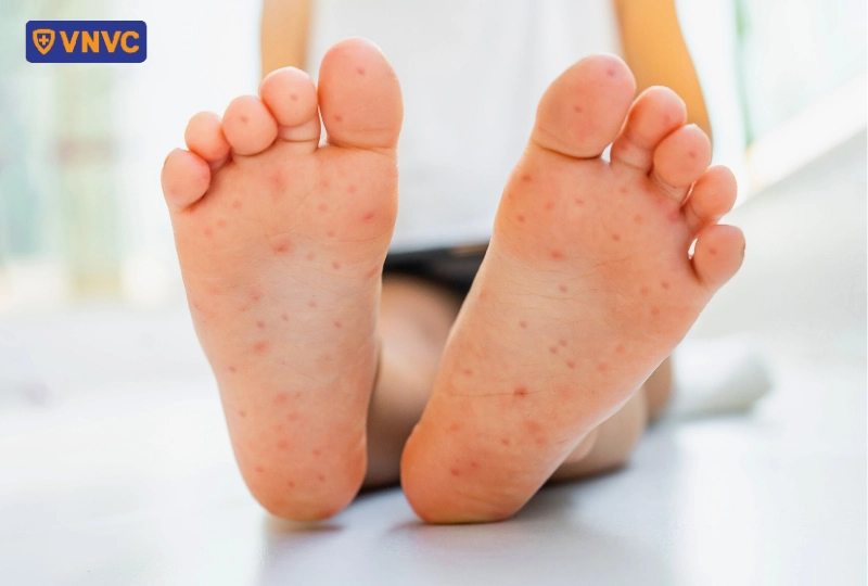 dấu hiệu bệnh tay chân miệng trên chân
