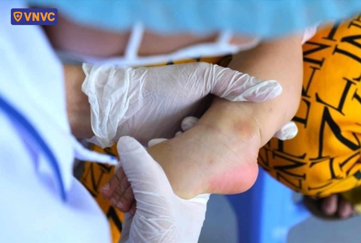 nhiều ca tay chân miệng nhấp viện