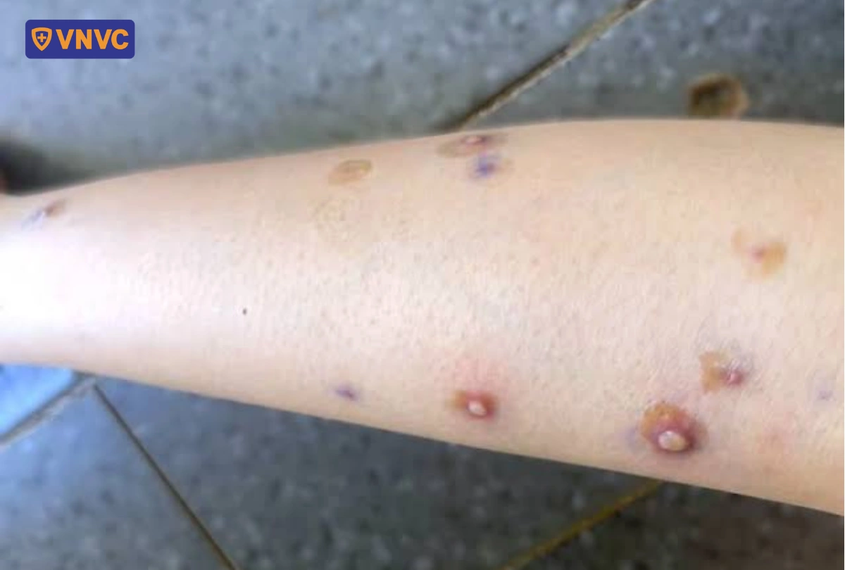 vùng da bị nổi mụn nước