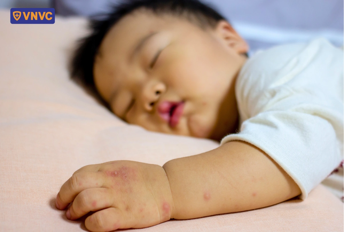 bé nổi nốt tay chân miệng trên tay
