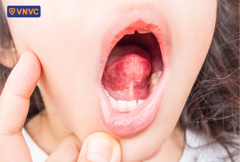 biểu hiện loét miệng của tay chân miệng