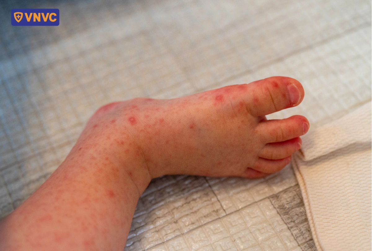 các nốt mụn tay chân miệng ở chân
