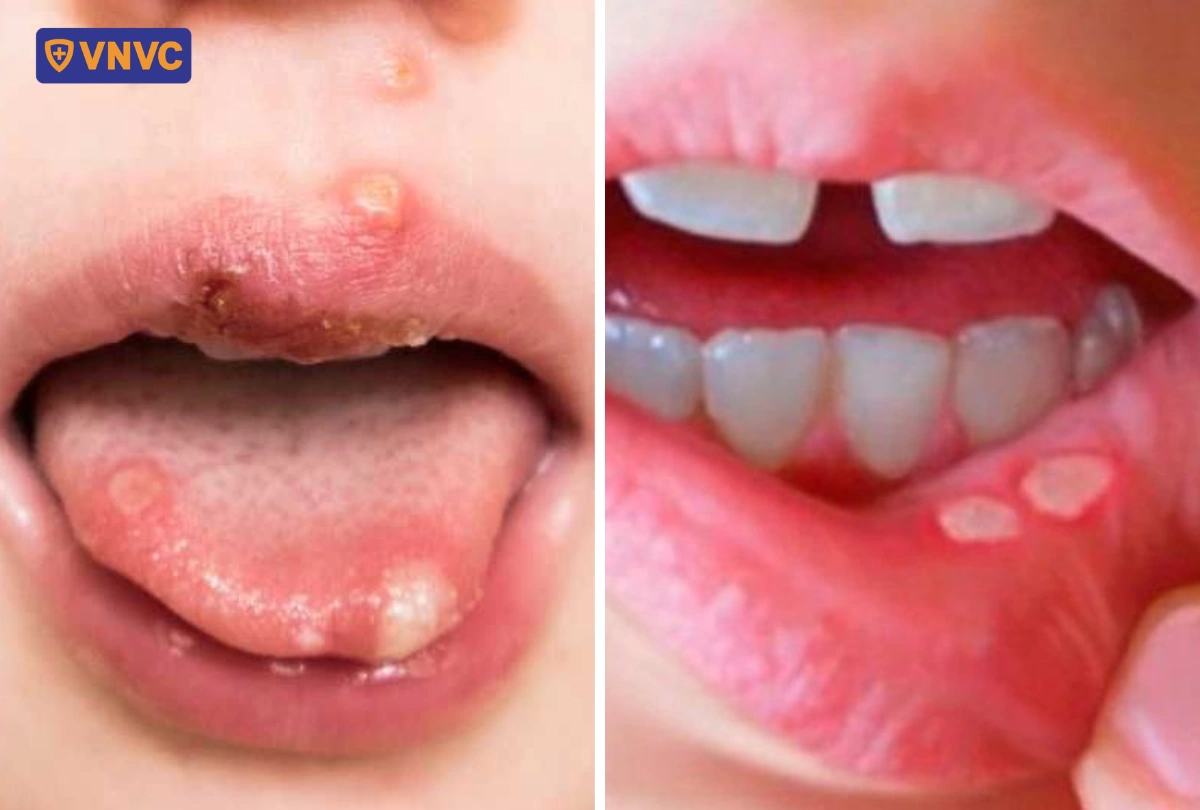 các vết loét của tay chân miệng