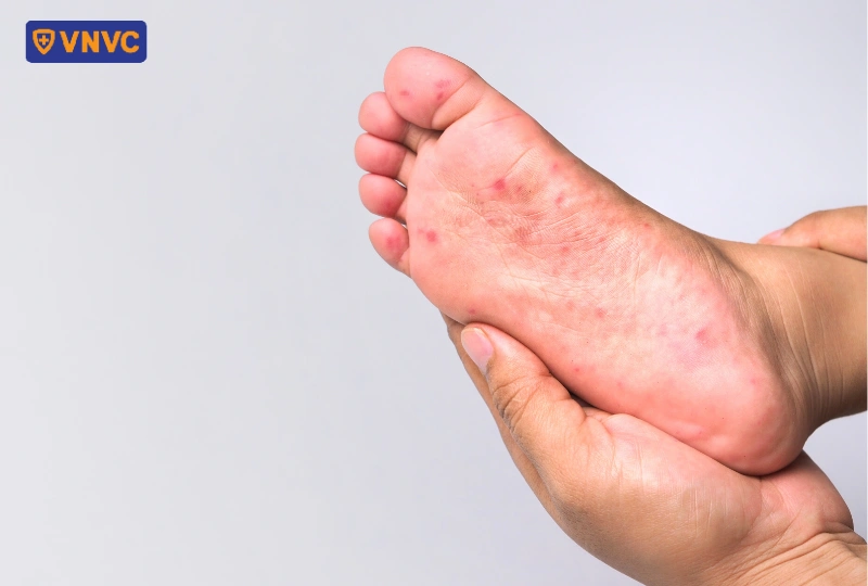 dấu hiệu tay chân miệng ở trẻ em