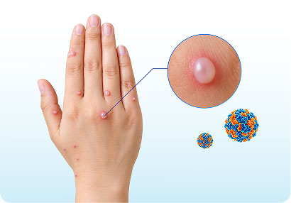 Lây qua dịch từ các nốt phỏng