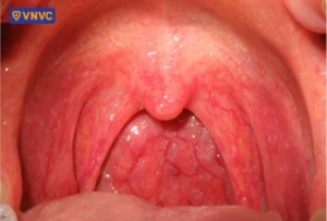 niêm mạc cổ họng bị viêm sưng đỏ