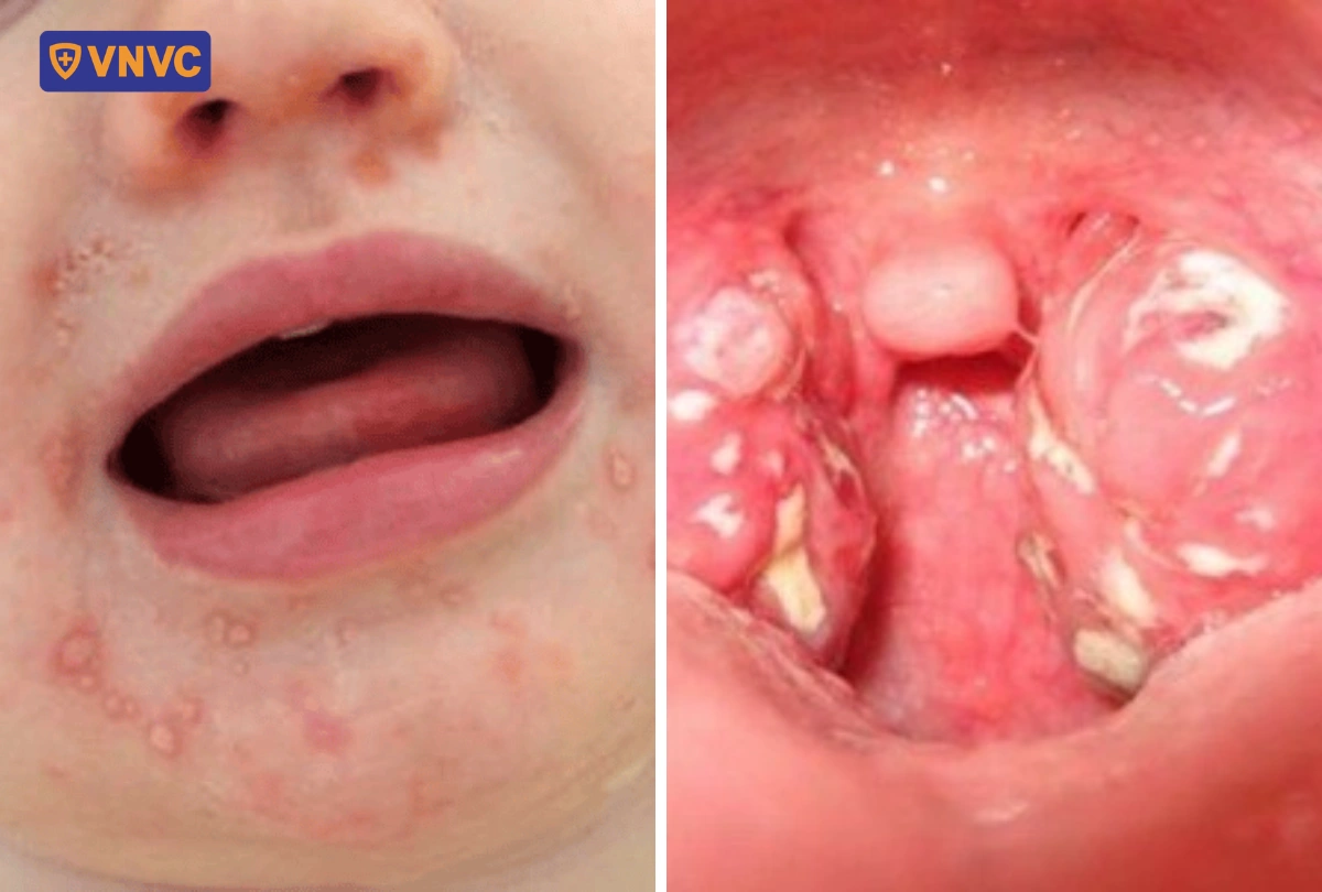tay chân miệng gây viêm loét