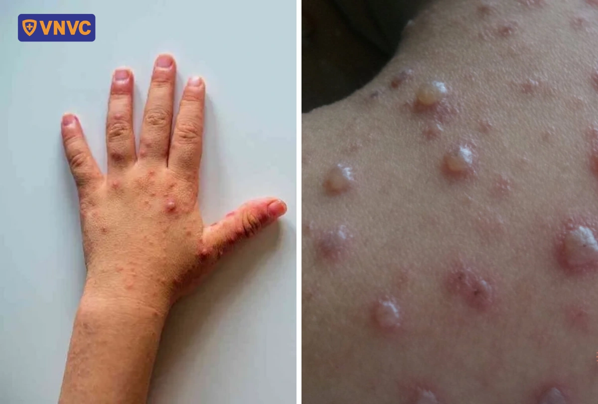 triệu chứng mụn nước của tay chân miệng