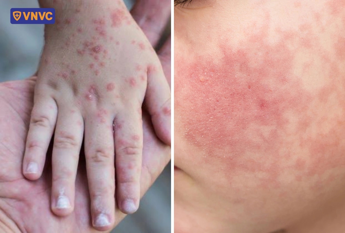 triệu chứng phỏng nước do tay chân miệng
