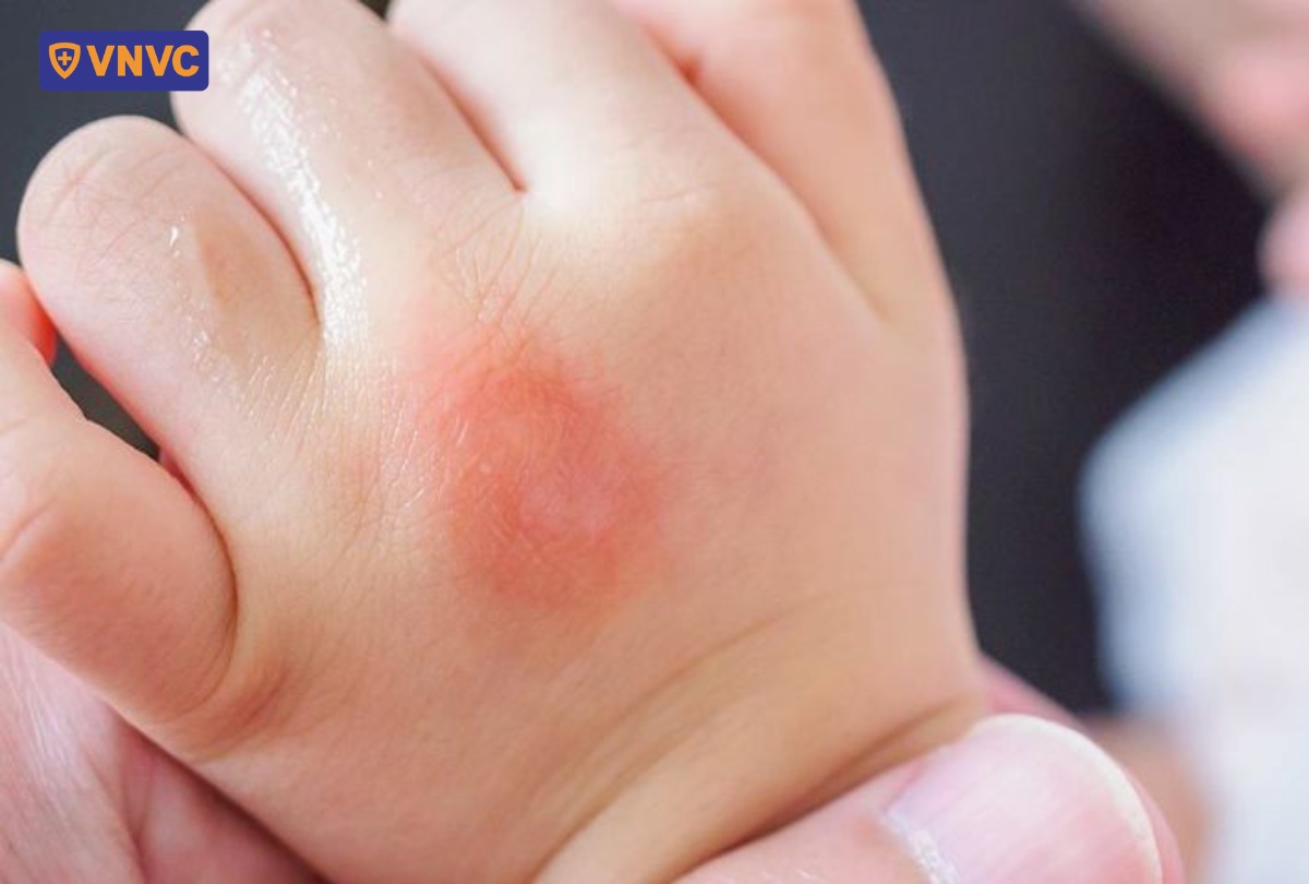 vết muỗi đốt trên tay