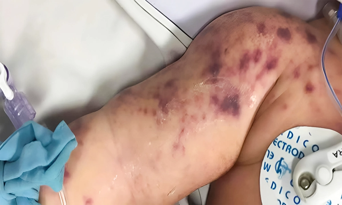 widespread purple rash spots on infant skin at hospital